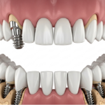 Smile Transformation