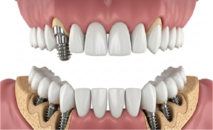Smile Transformation